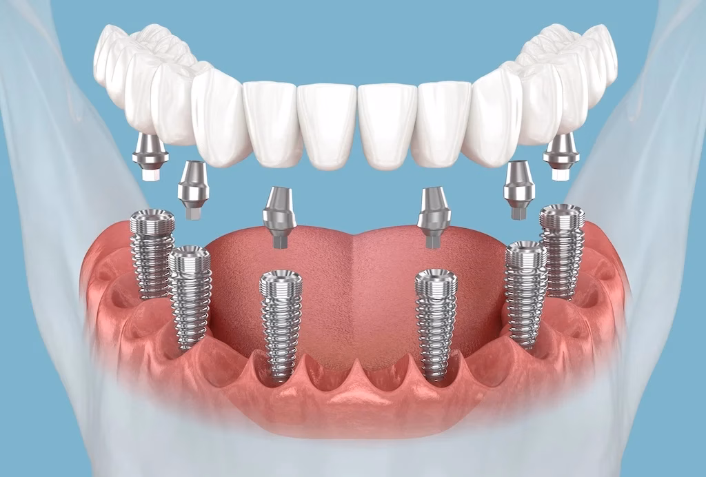 How Painful Is Getting a Dental Implant?
