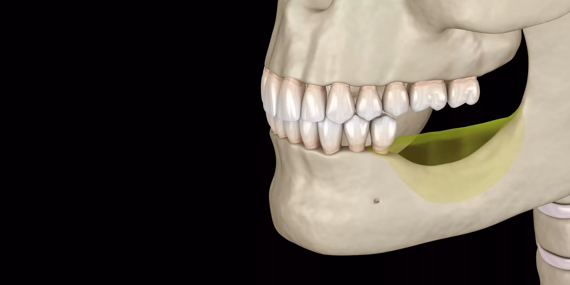 Can You Get Dental Implants With Bone Loss?