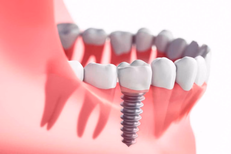 How Long Do Dental Implants Last?